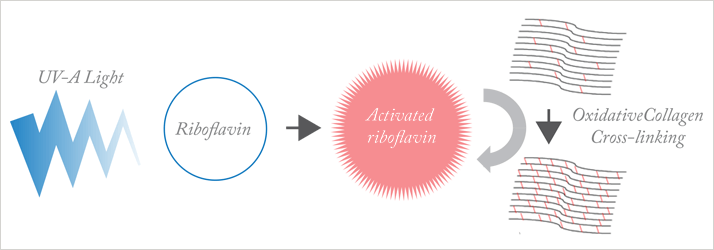 Figure 1. Main principles of photo-oxidative corneal cross-linking. 
