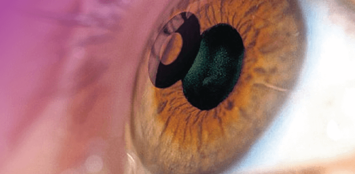 Mainteaser of Building a Presbyopia Practice