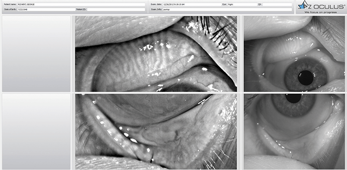 Example of Keratograph 5M Meibography