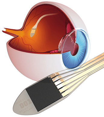 1114-302-retina-345